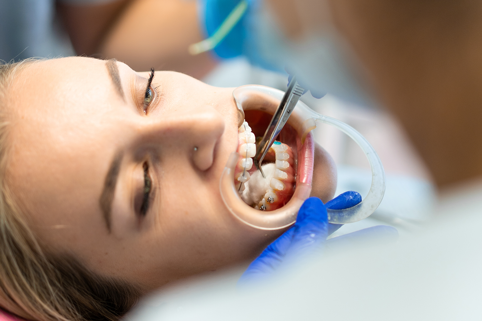 Veneers